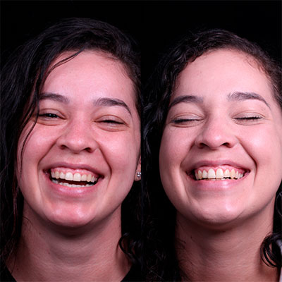 Periodontia Gengivoplastia