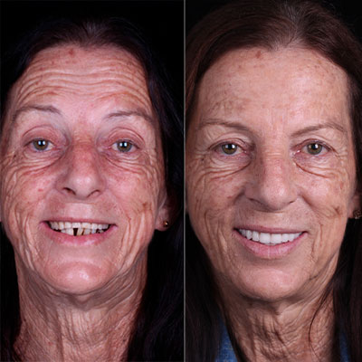 Protocolo e Carga Imediata