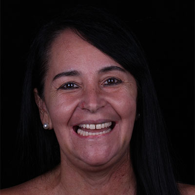 Protocolo e Carga Imediata